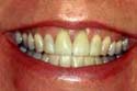 Before San Diego California Teeth Whitening